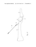 FIXATION IMPLANT AND METHOD diagram and image