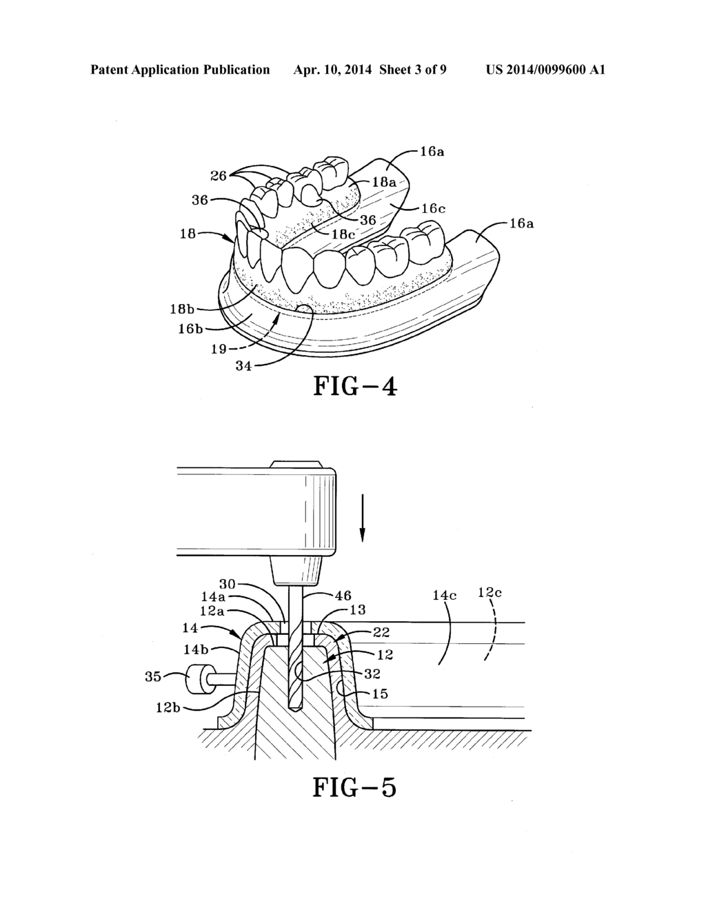 METHOD OF INSTALLING A FINAL DENTAL PROSTHESIS - diagram, schematic, and image 04