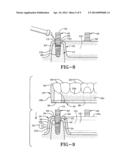 METHOD OF INSTALLING A FINAL DENTAL PROSTHESIS diagram and image