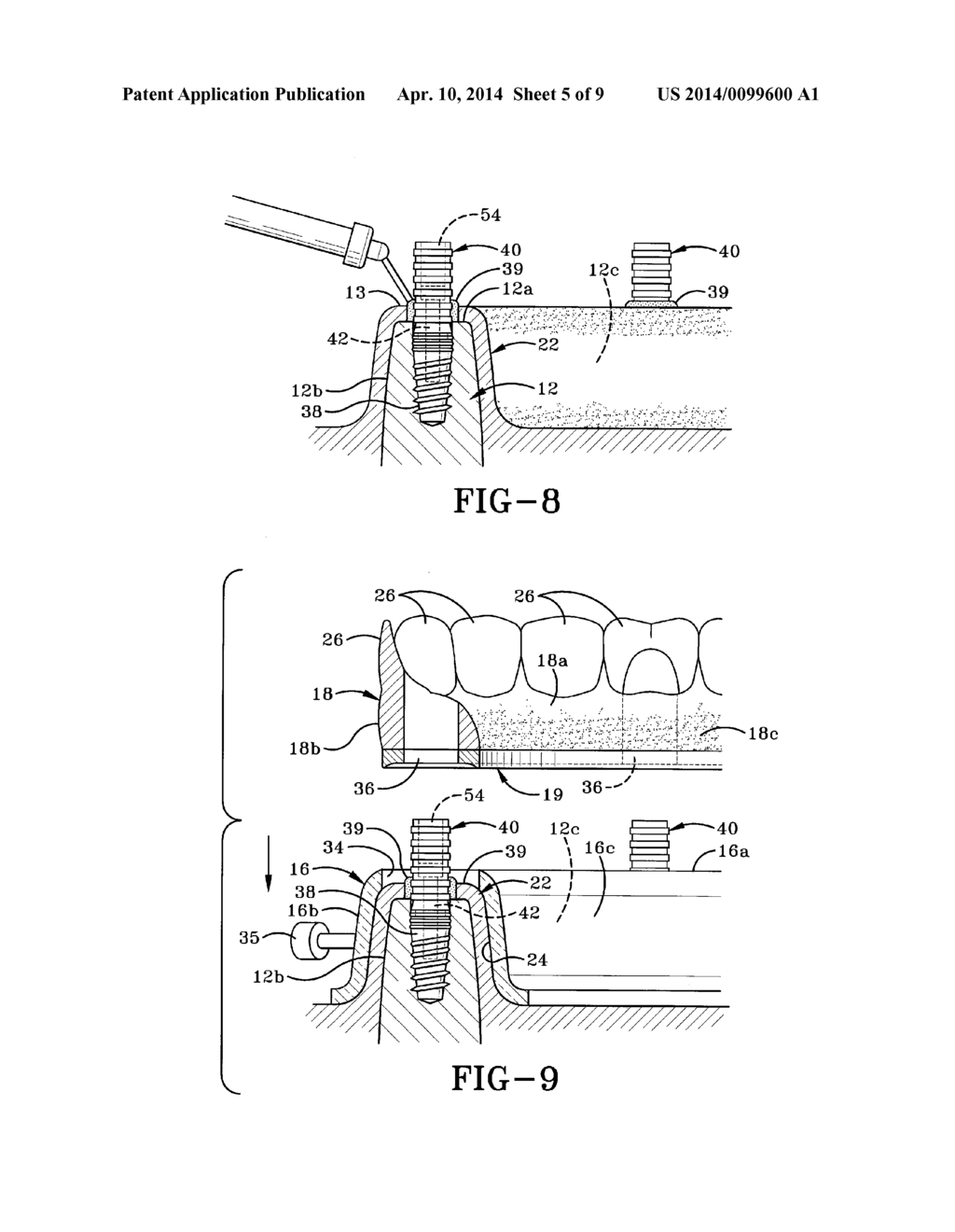 METHOD OF INSTALLING A FINAL DENTAL PROSTHESIS - diagram, schematic, and image 06