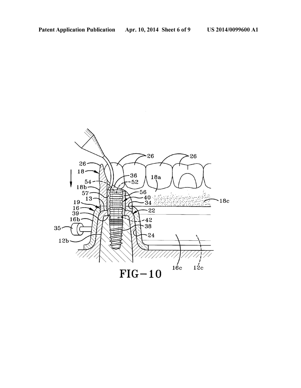 METHOD OF INSTALLING A FINAL DENTAL PROSTHESIS - diagram, schematic, and image 07