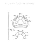 METHOD OF INSTALLING A FINAL DENTAL PROSTHESIS diagram and image