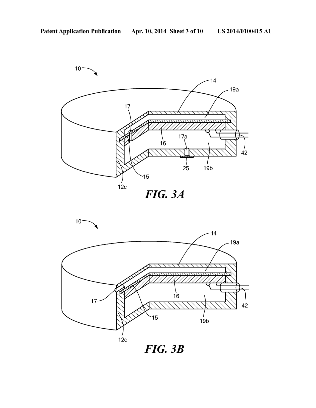 IMPLANTABLE MICROPHONE FOR HEARING SYSTEMS - diagram, schematic, and image 04