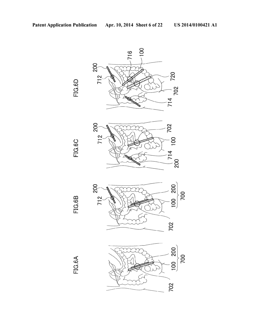 METHOD OF PLACING MEDICAL INSERTION INSTRUMENTS IN BODY CAVITY - diagram, schematic, and image 07