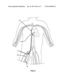 HYBRID ARTERIOVENOUS SHUNT diagram and image