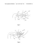 METHOD AND APPARATUS FOR REDUCING OBESITY diagram and image