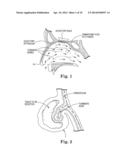 ELECTROSURGICAL DEVICE FOR CUTTING AND REMOVING TISSUE diagram and image