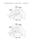 ELECTROSURGICAL DEVICE FOR CUTTING AND REMOVING TISSUE diagram and image