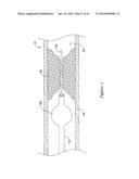 MEDICAL DEVICE HAVING AN ELECTRO-MAGNETIC DEVICE TIP AND RELATED METHOD OF     USE diagram and image