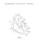 SYSTEM AND METHOD FOR TRANSAPICAL ACCESS AND CLOSURE diagram and image