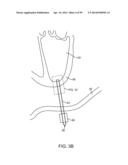 SYSTEM AND METHOD FOR TRANSAPICAL ACCESS AND CLOSURE diagram and image