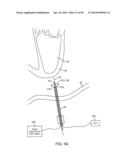 SYSTEM AND METHOD FOR TRANSAPICAL ACCESS AND CLOSURE diagram and image