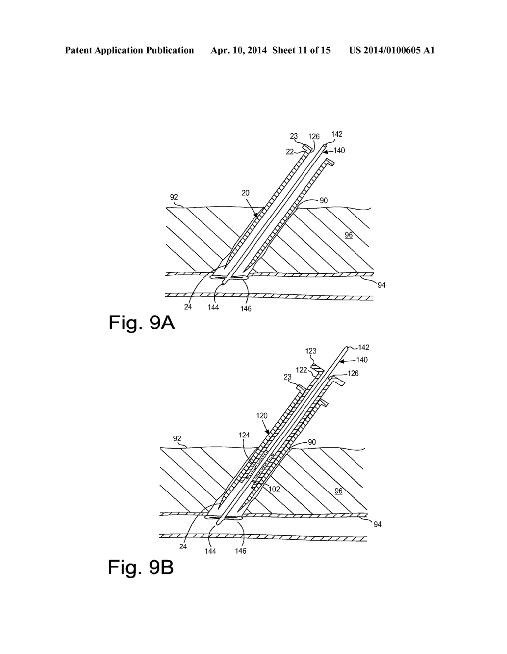 APPARATUS AND METHODS FOR SEALING A VASCULAR PUNCTURE - diagram, schematic, and image 12