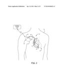 CARDIAC PACING DURING MEDICAL PROCEDURES diagram and image