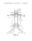 ENDOVASCULAR GRAFT FOR ANEURYSMS INVOLVING MAJOR BRANCH VESSELS diagram and image