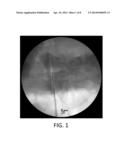 SYSTEM AND METHOD FOR PERFORMING A TRANSILIAC APPROACH FOR L5-S1     DISCECTOMY AND FUSION diagram and image