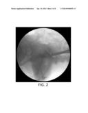 SYSTEM AND METHOD FOR PERFORMING A TRANSILIAC APPROACH FOR L5-S1     DISCECTOMY AND FUSION diagram and image