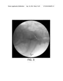 SYSTEM AND METHOD FOR PERFORMING A TRANSILIAC APPROACH FOR L5-S1     DISCECTOMY AND FUSION diagram and image