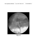 SYSTEM AND METHOD FOR PERFORMING A TRANSILIAC APPROACH FOR L5-S1     DISCECTOMY AND FUSION diagram and image