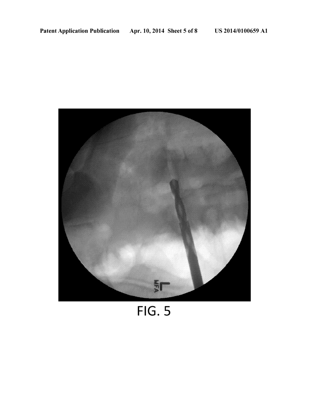 SYSTEM AND METHOD FOR PERFORMING A TRANSILIAC APPROACH FOR L5-S1     DISCECTOMY AND FUSION - diagram, schematic, and image 06