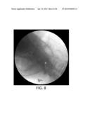 SYSTEM AND METHOD FOR PERFORMING A TRANSILIAC APPROACH FOR L5-S1     DISCECTOMY AND FUSION diagram and image