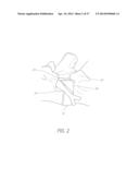 METHOD AND APPARATUS FOR MINIMALLY INVASIVE INSERTION OF INTERVERTEBRAL     IMPLANTS diagram and image