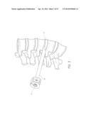 METHOD AND APPARATUS FOR MINIMALLY INVASIVE INSERTION OF INTERVERTEBRAL     IMPLANTS diagram and image