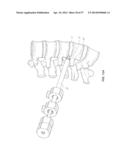 METHOD AND APPARATUS FOR MINIMALLY INVASIVE INSERTION OF INTERVERTEBRAL     IMPLANTS diagram and image