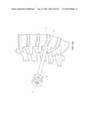 METHOD AND APPARATUS FOR MINIMALLY INVASIVE INSERTION OF INTERVERTEBRAL     IMPLANTS diagram and image