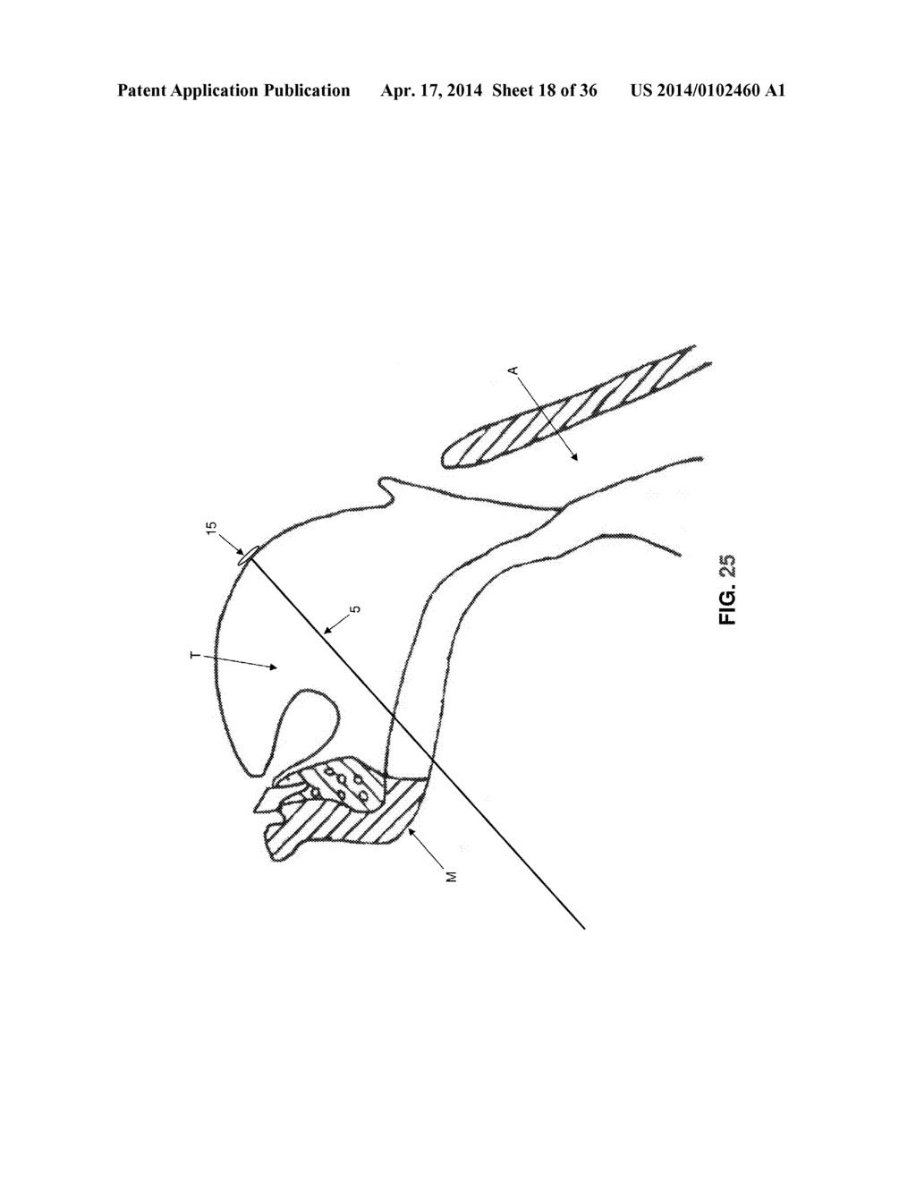 METHOD AND APPARATUS FOR TREATING OBSTRUCTIVE SLEEP APNEA (OSA) - diagram, schematic, and image 19