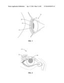 FULL-EYE ILLUMINATION OCULAR SURFACE IMAGING OF AN OCULAR TEAR FILM FOR     DETERMINING TEAR FILM THICKNESS AND/OR PROVIDING OCULAR TOPOGRAPHY diagram and image