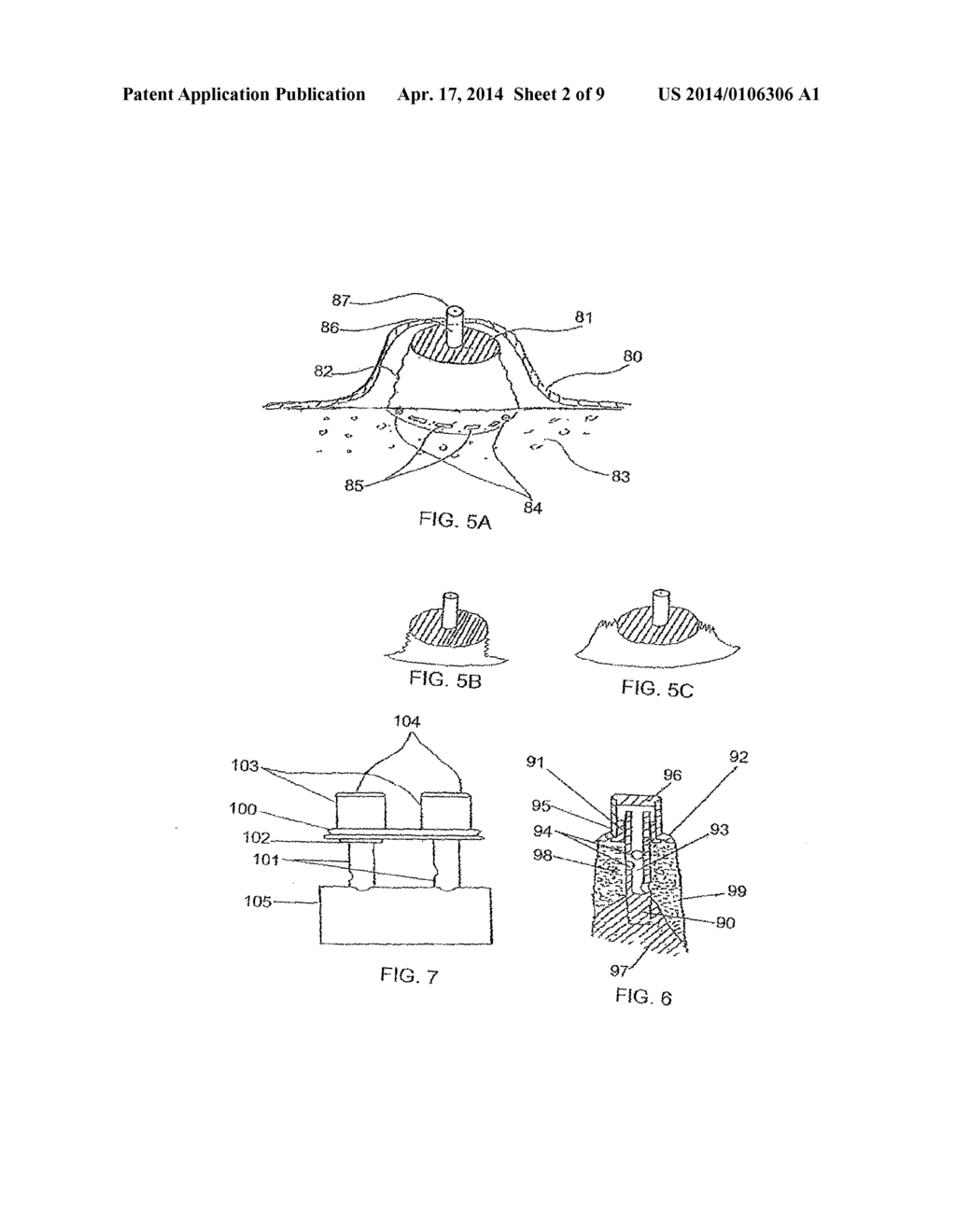 Method for enlarging a jaw bone using a hollow dental implant having a     side perforation - diagram, schematic, and image 03