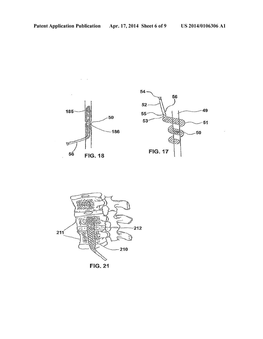 Method for enlarging a jaw bone using a hollow dental implant having a     side perforation - diagram, schematic, and image 07