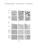 BIOMARKERS FOR AGGRESSIVE PROSTATE CANCER diagram and image