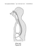 SENSING CATHETER EMITTING RADIANT ENERGY diagram and image