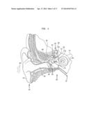 EVALUATION OF AN IMPLANTED PROSTHESIS diagram and image