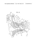 EVALUATION OF AN IMPLANTED PROSTHESIS diagram and image