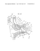 EVALUATION OF AN IMPLANTED PROSTHESIS diagram and image