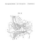 EVALUATION OF AN IMPLANTED PROSTHESIS diagram and image