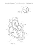 CATHETER GUIDANCE THROUGH A CALCIFIED AORTIC VALVE diagram and image