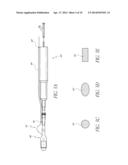 CATHETER GUIDANCE THROUGH A CALCIFIED AORTIC VALVE diagram and image