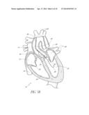 CATHETER GUIDANCE THROUGH A CALCIFIED AORTIC VALVE diagram and image