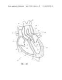 CATHETER GUIDANCE THROUGH A CALCIFIED AORTIC VALVE diagram and image