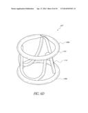 CATHETER GUIDANCE THROUGH A CALCIFIED AORTIC VALVE diagram and image