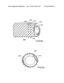 EXPANDABLE IMPLANT DEVICES FOR FILTERING BLOOD FLOW FROM ATRIAL APPENDAGES diagram and image