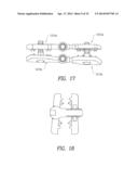 SPINOUS PROCESS DEVICE AND METHOD OF USE diagram and image