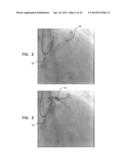 AUTOMATIC ANGIOGRAM DETECTION diagram and image