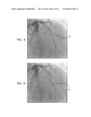 AUTOMATIC ANGIOGRAM DETECTION diagram and image