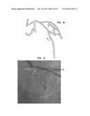 AUTOMATIC ANGIOGRAM DETECTION diagram and image