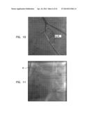 AUTOMATIC ANGIOGRAM DETECTION diagram and image